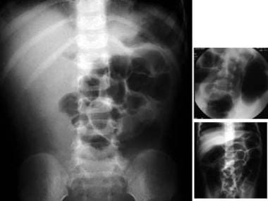 
Left: Radiograph from a 14-month-old boy who expe