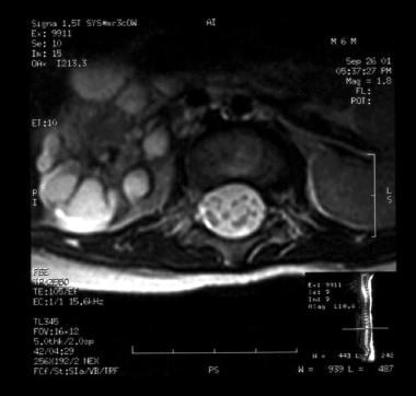 A T2-weighted MRI scan of the same patient as in t