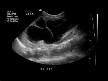 Longitudinal image of the right kidney demonstrate