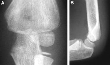 Subtle lateral condyle fracture. Anteroposterior (