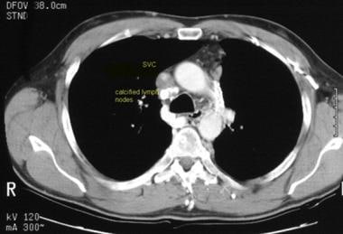 Superior vena cava syndrome (case 1). The patient 