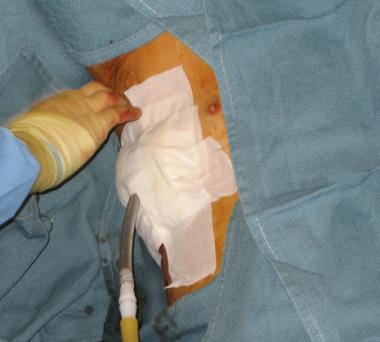 Apply support gauze dressing around the chest tube