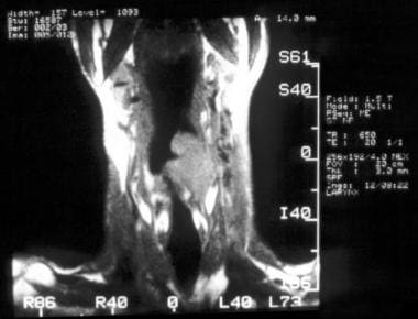 MR imaging, larynx. Sagittal T1-weighted MRI of th