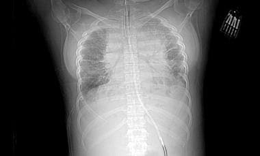 一个16岁的青少年的胸部射线照片