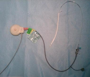 An intrauterine pressure catheter and cable. 