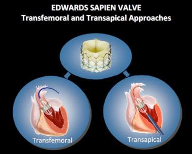 Transcatheter Aortic Valve Replacement (TAVR). Edw