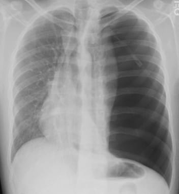 Tension pneumothorax.