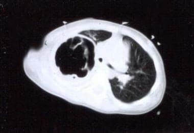 Chest CT scan of pneumonia with pneumatocele. 