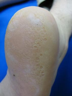 Pitted keratolysis with hyperkeratosis on the heel