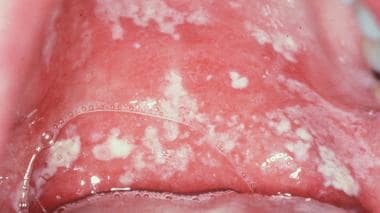 atrophic candidiasis