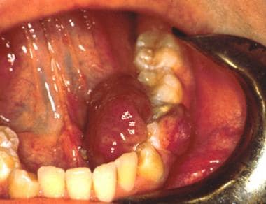 Same patient as in Image 4 with a lesion that recu