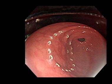 Endoscopic submucosal dissection (ESD). Thermal mu