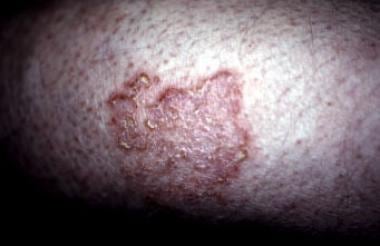 Discoid eczema