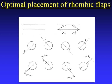 Optimal placement of rhombic flaps. 