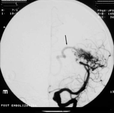 Angiogram (anteroposterior view) showing an arteri