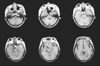 MRI of the brain in a patient with TBM and concurr