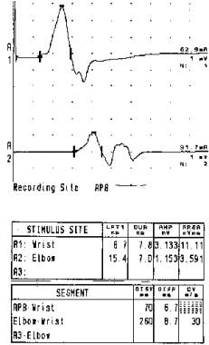 Electromyography of a patient with chronic inflamm