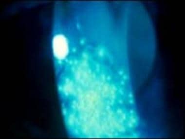 Stromal puncture seen with fluorescein. 