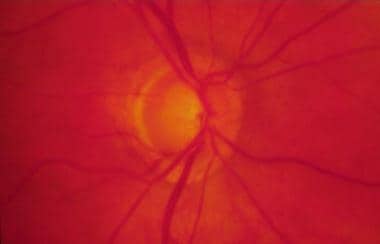 Glaucomatous optic nerve damage, with sloping and 