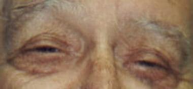 Patient with bilateral ptosis before surgery. 