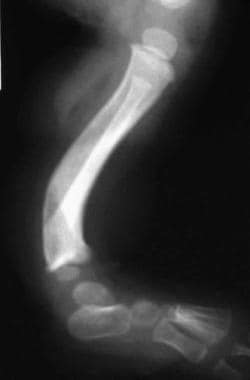 Lateral radiograph of a 1-year-old child with post