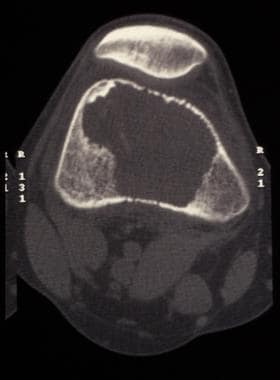 Giant cell tumor. CT scan of distal femur reveals 