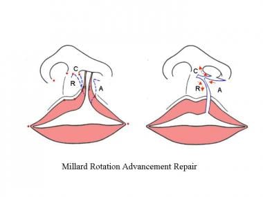 Millard repair. The medial lip element [R] is rota