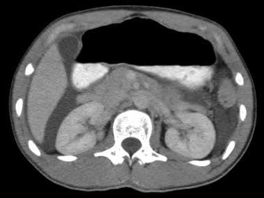 Ascites. This computed tomography scan demonstrate