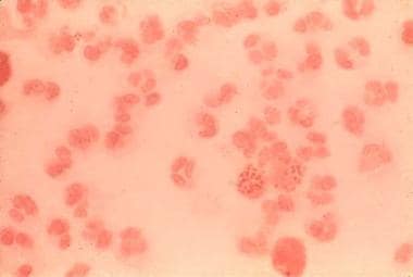 Gonorrhea: Practice Essentials, Background, Pathophysiology