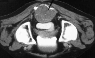 This pelvic CT scan shows a large presacral mass e