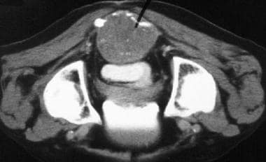 盆腔CT扫描显示一个巨大的骶前肿块