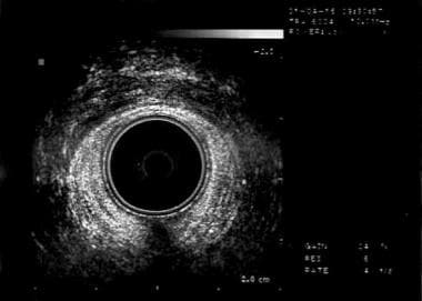 Fecal Incontinence Workup: Laboratory Studies, Imaging Studies ...