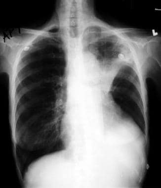 Atelectasis. Left upper lobe collapse showing opac