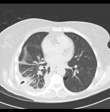 Chest CT scan with intravenous contrast in a patie