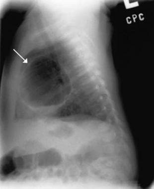 Lateral chest radiograph (same patient as in Image