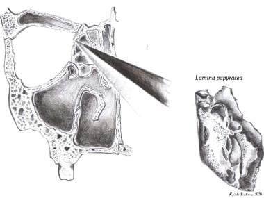 Lamina papyracea. 