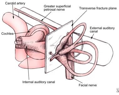 Potential fracture plane and structures involved i