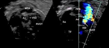 Subcostal "right ventricular inflow/outflow" view 