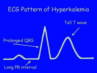 Pediatric Diabetic Ketoacidosis. A graphical repre