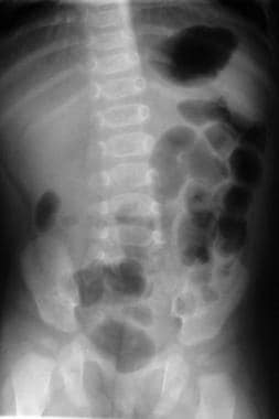 intussusception x ray