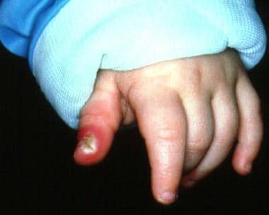 Herpes whitlow in an infant. 