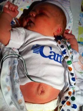 Pediatric omphalocele and gastroschisis (abdominal