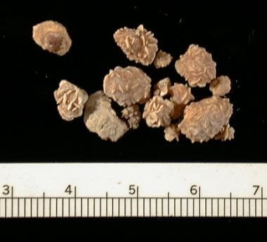 uric acid kidney stones