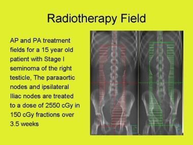 Radiotherapy fields for stage I seminoma. 