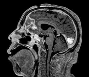 Brain MRI (sagittal view) in a patient with uncont