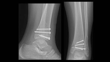 Growth plate (physeal) fractures. Healed triplane 
