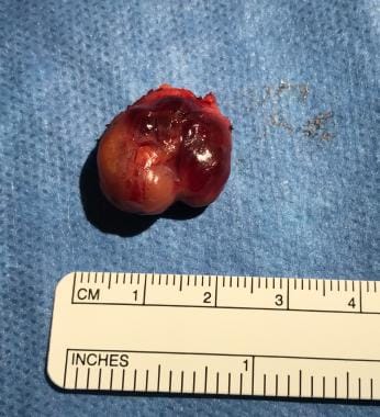 This left superior parathyroid gland weighed 2 gra