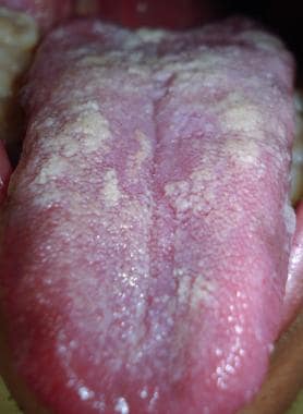 Pseudomembranous form affecting the tongue. Courte