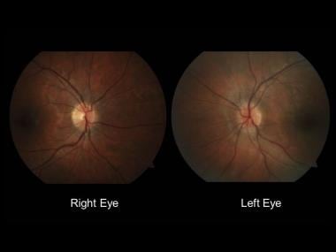 Normal-appearing right optic nerve and mild left o