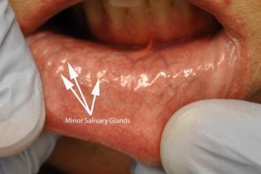 Minor salivary glands seen through the mucosa. 